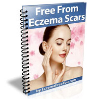 Free From Eczema Scars - Eczema Free You Free From Eczema Scars - Eczema Free You